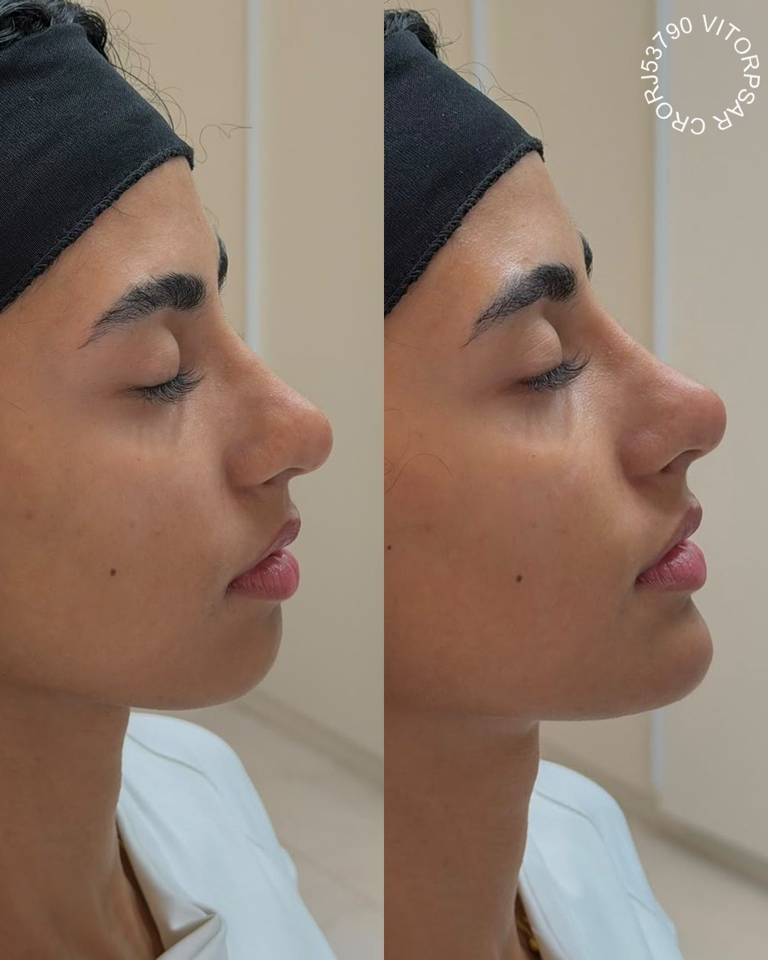 Contorno Facial, antes e depois