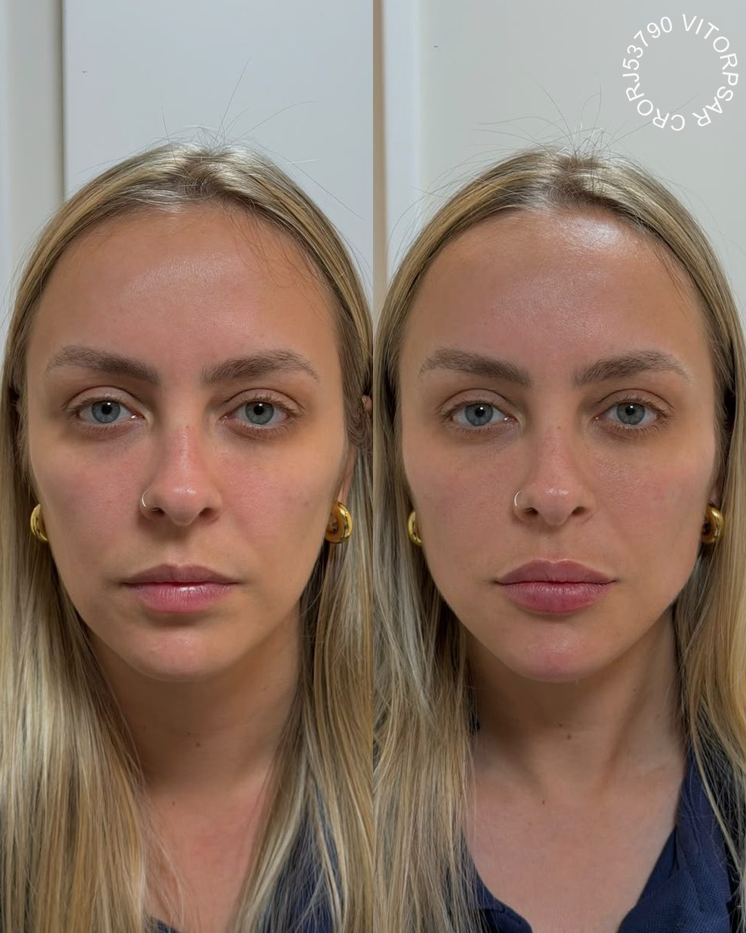 Full Face, antes e depois