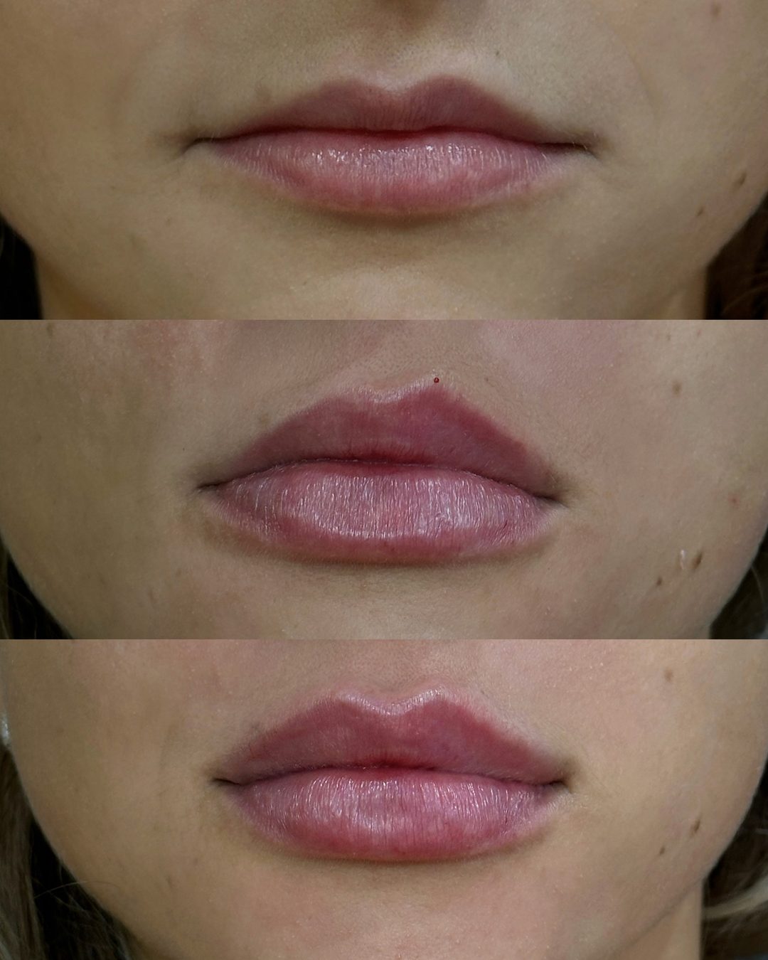 Preenchimento Labial, antes e depois