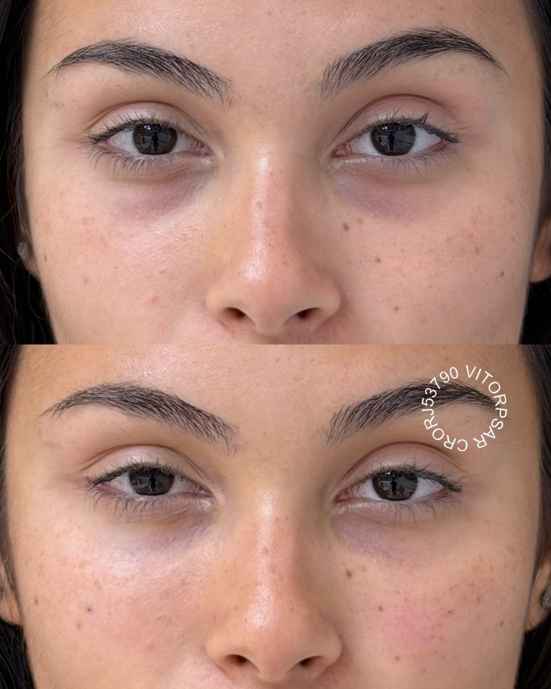 Preenchimento de Olheiras, antes e depois