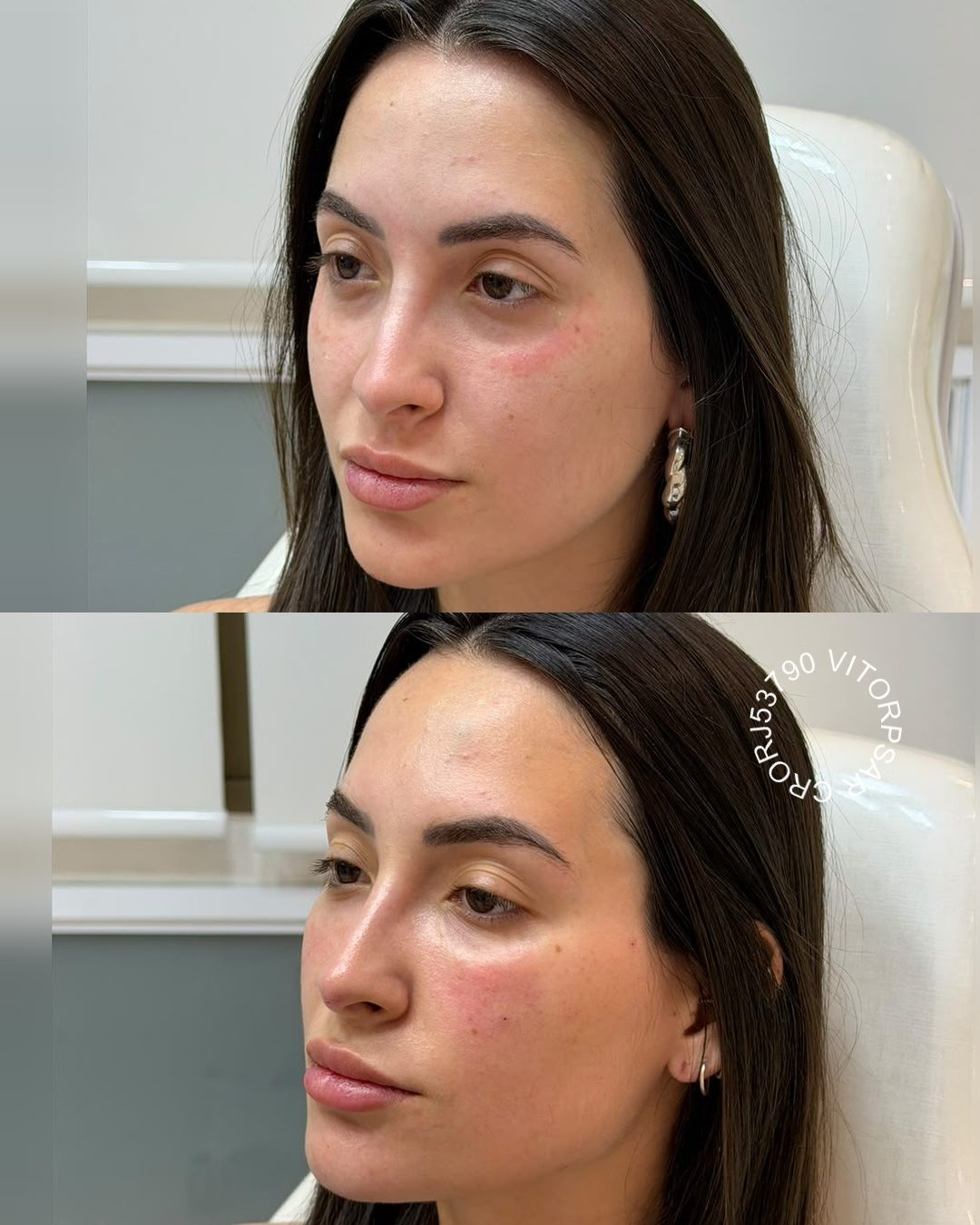 Reestruturação Facial, antes e depois