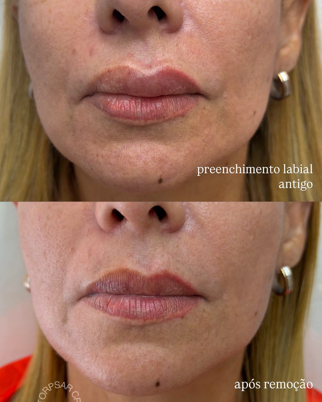 Remoção de preenchimento labial, antes e depois
