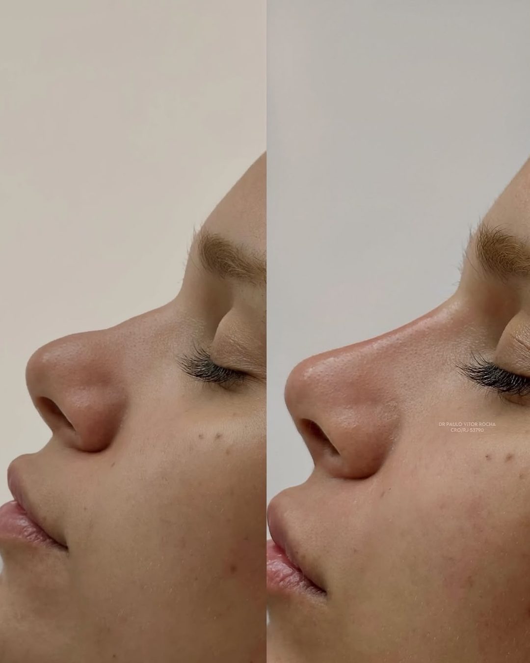 Rinomodelação, antes e depois
