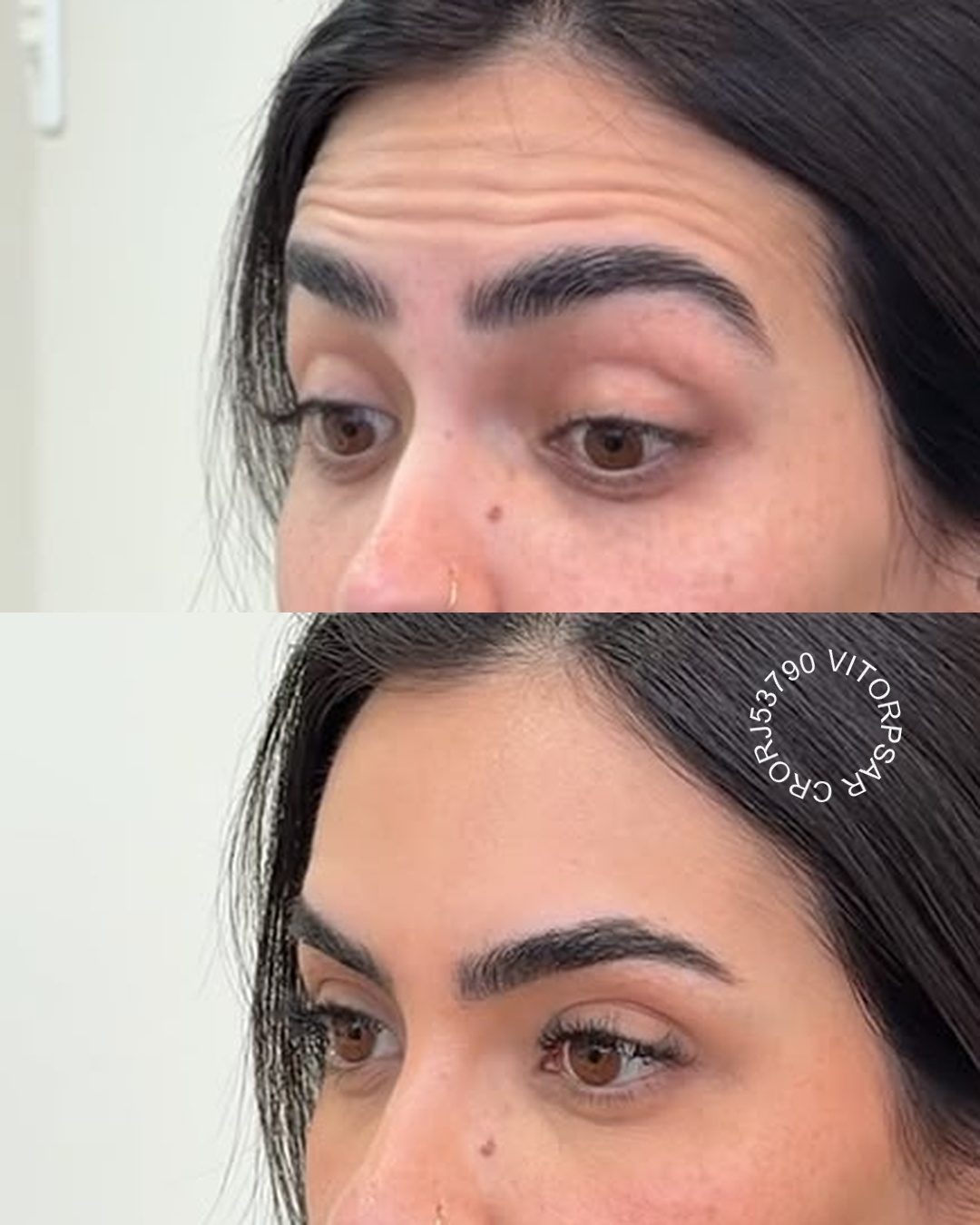 Toxina Botulínica, antes e depois